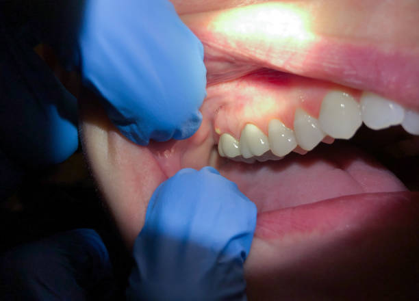 Best Emergency Dental Extractions in Milford Mill, MD